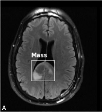 Brain MRI with an annotated abnormal region used to compare reconstruction quality